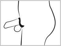 Voorbeeld: Penis Käfig mit Dilator