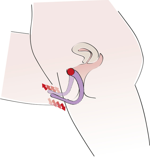 labia-spreiders-applicatie-tekening-zijde-verslaving